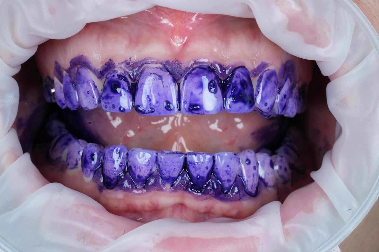 Biofilm disclosed in purple across the upper and lower teeth before Guided Biofilm Therapy