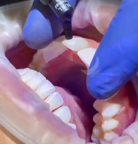Composite bonding being layered by hand