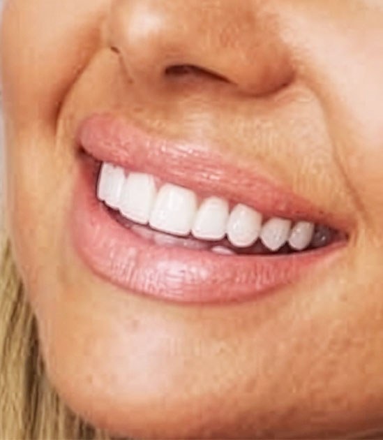 A natural-looking cosmetic result
