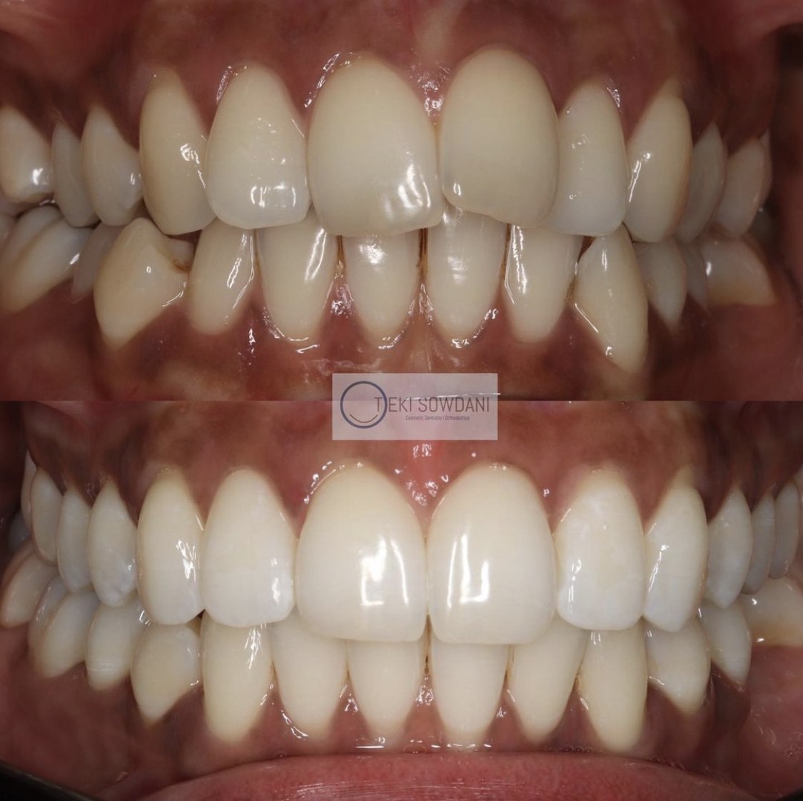 A brightened, even smile after treatment