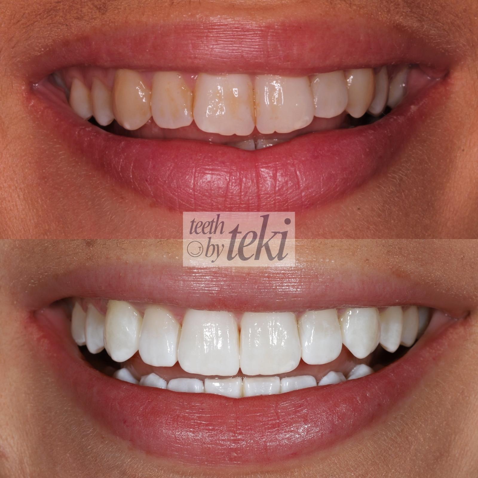 Before and after smile result following Invisalign treatment