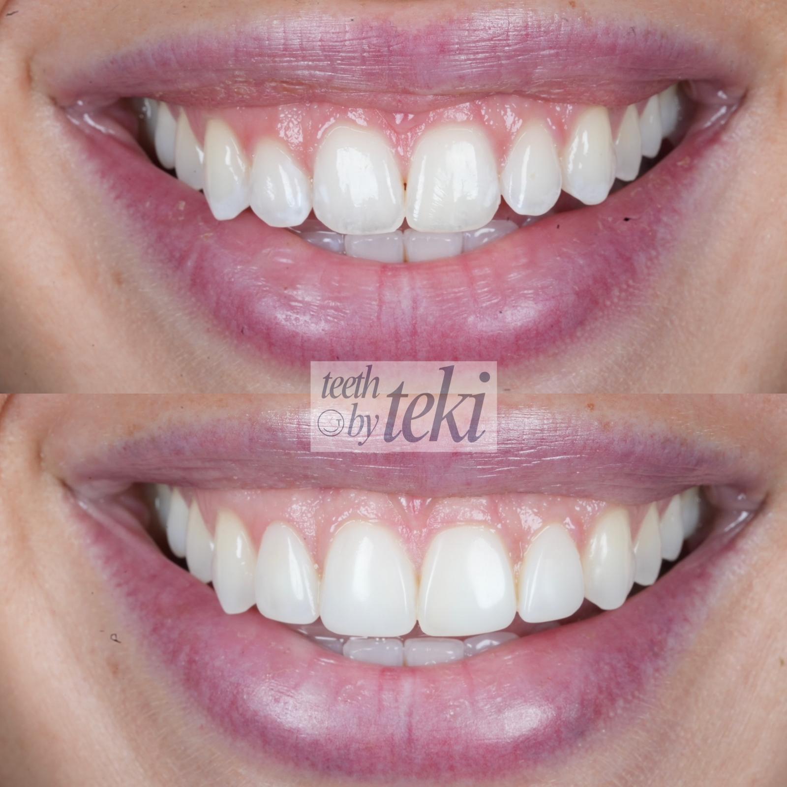 Before and after smile showing a more even gumline after laser contouring