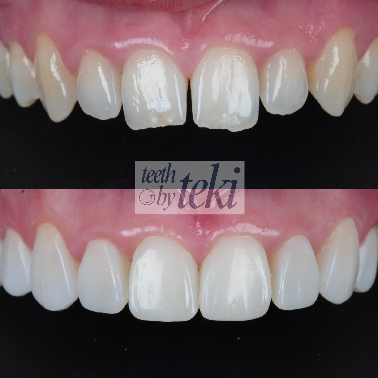 Before and after close-up of composite bonding on the upper front teeth