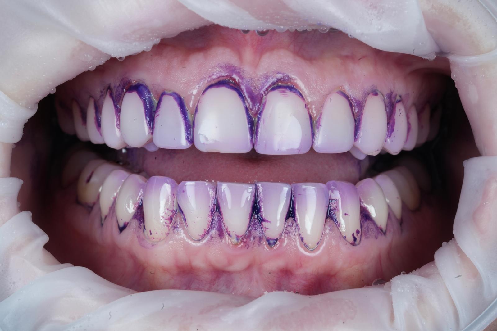Disclosed biofilm being cleared from the gumline during Guided Biofilm Therapy